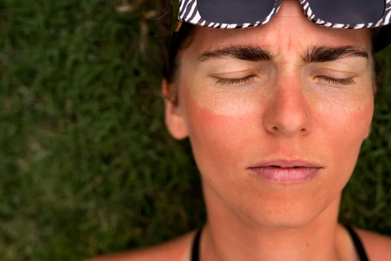 1-portrait-adult-woman-with-sunburn-skin