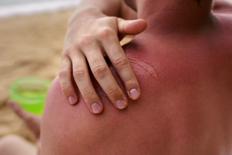 1-view-man-applying-lotion-sunburn-skin-beach