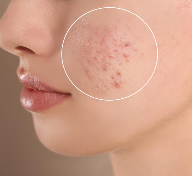 Why Mineral Sunscreen Is a Wise Option for Acne-Prone Skin Types